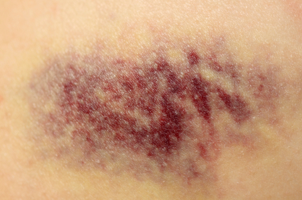 Erase Those Bruises with This Herbal Cream