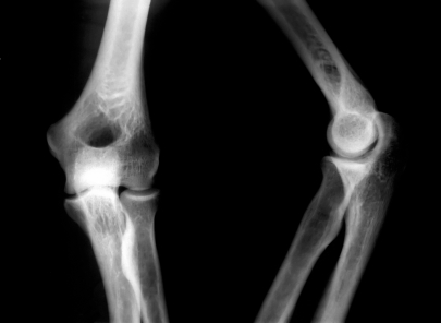 This surprising vitamin keeps bones strong and dense. Without it your risk for fractures goes up 70 percent.