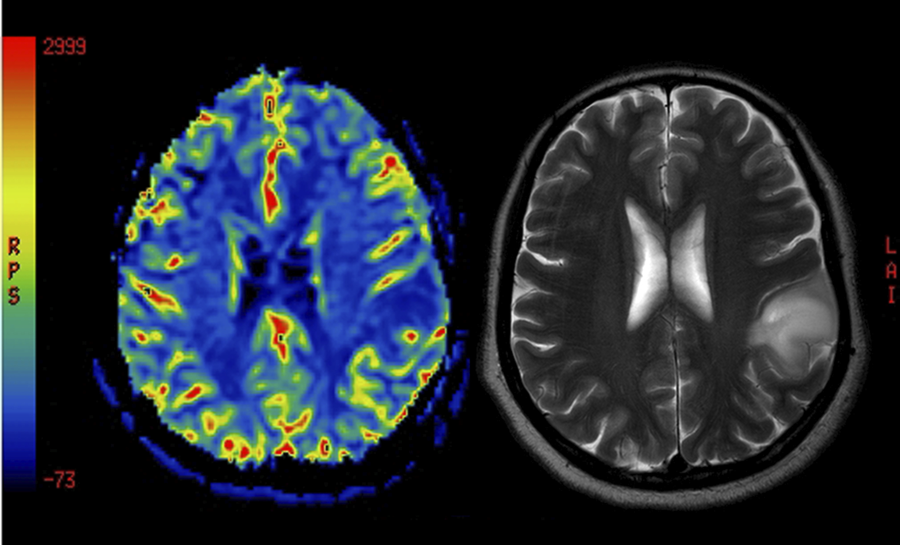 Short telomeres may accelerate aging and cause disease… But a new study reveals that longer telomeres may play a role in certain forms of deadly brain cancers.