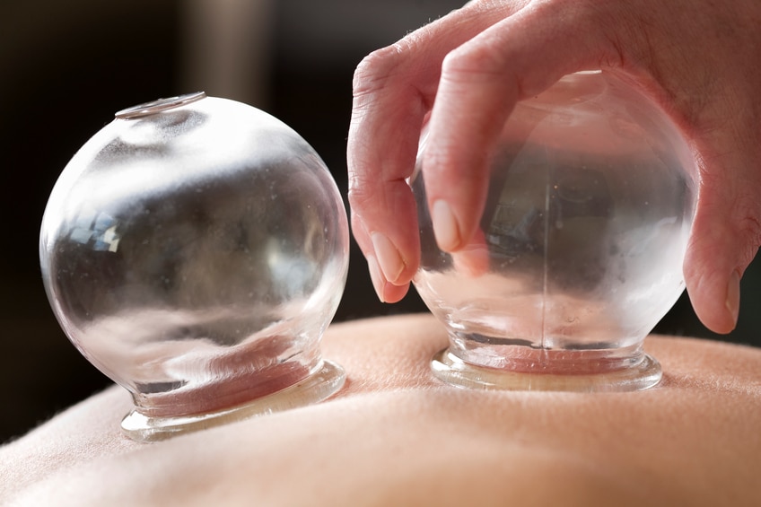 Michael Phelps is using cupping therapy during Olympic competition. If you suffer from back pain, the ancient practice may provide natural relief.