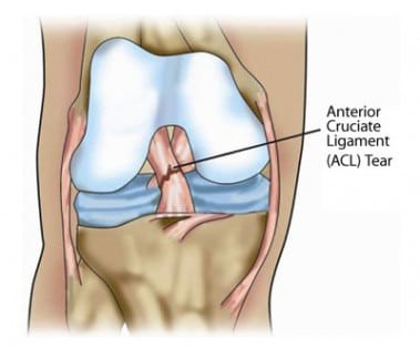 Image of ACL.