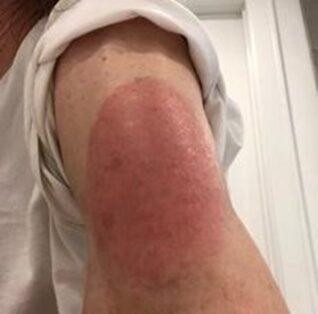 Picture of rash.